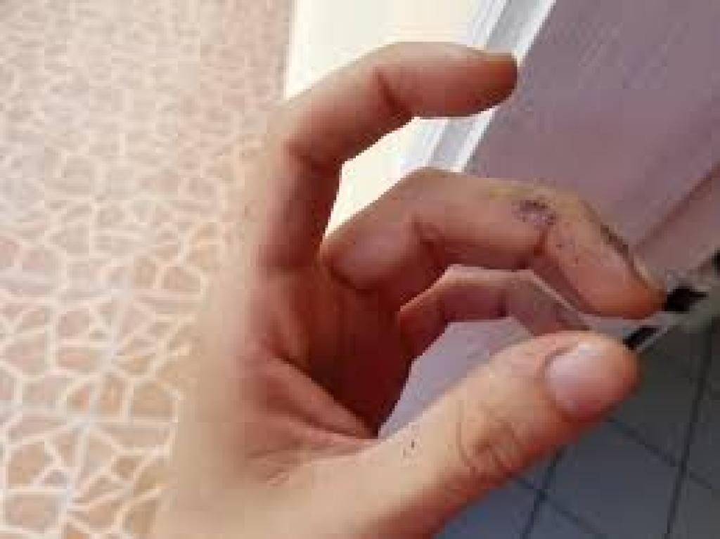 Toxicity of Silver Nitrate